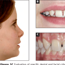 Missing lateral incisors canine substitution