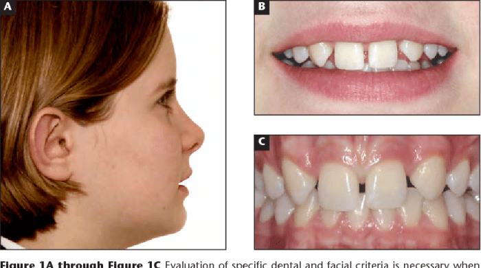 Missing lateral incisors canine substitution