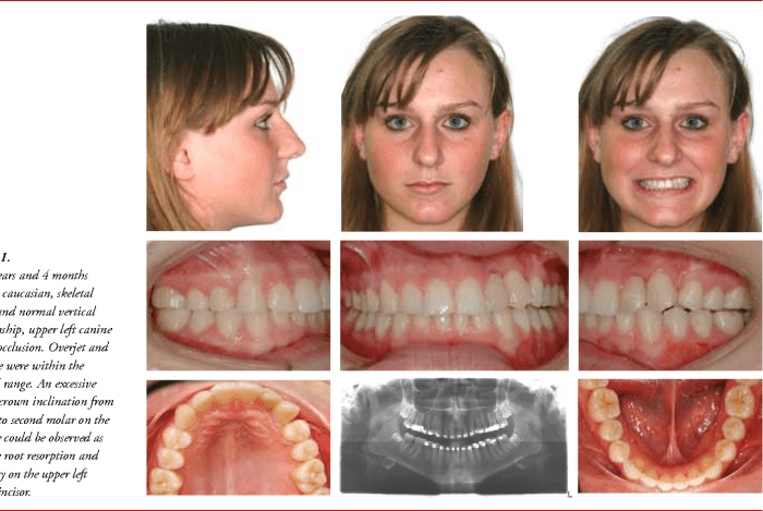 Mouth smile canine lateral missing incisors substitution both treatement pre