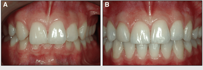 Missing lateral incisors canine substitution