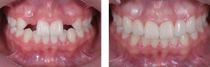 Lateral missing incisors smile composite correction using digital veneers guided kerr harmonize